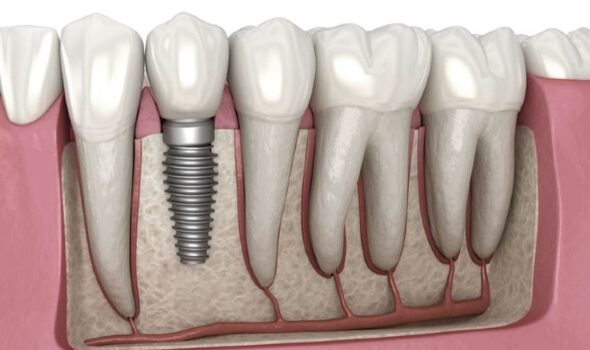 Dental-implant-illustration-1-1
