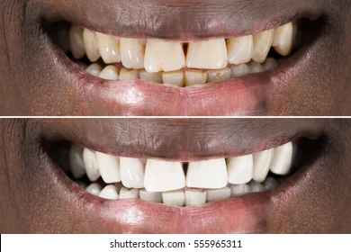 closeup-detail-smiling-man-teeth-260nw-555965311