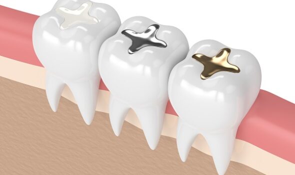 dental-fillings-2012-2